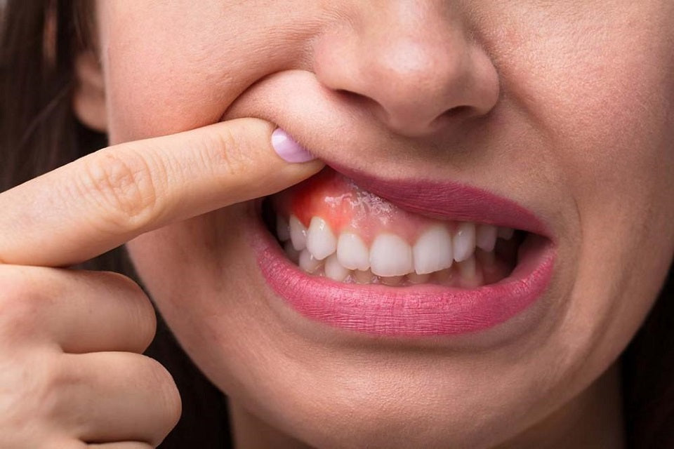 Guide to Gum Disease