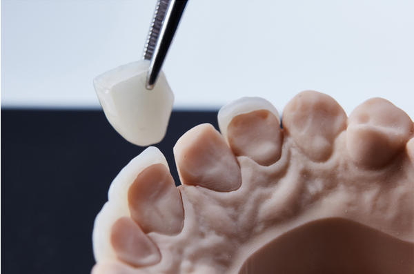 close-up-of-a-dental-model-with-a-porcelain-veneer-being-placed-by-a-dental-tool-showcasing-the-precision-and-artistry-of-restorative-treatments